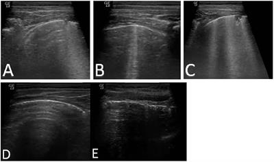 ECHOPAEDIA: Echography in Paediatric Patients in the Age of Coronavirus Disease 2019: Utility of Lung Ultrasound and Chest X-Ray in Diagnosis of Community-Acquired Pneumonia and Severe Acute Respiratory Syndrome Coronavirus 2 Pneumonia